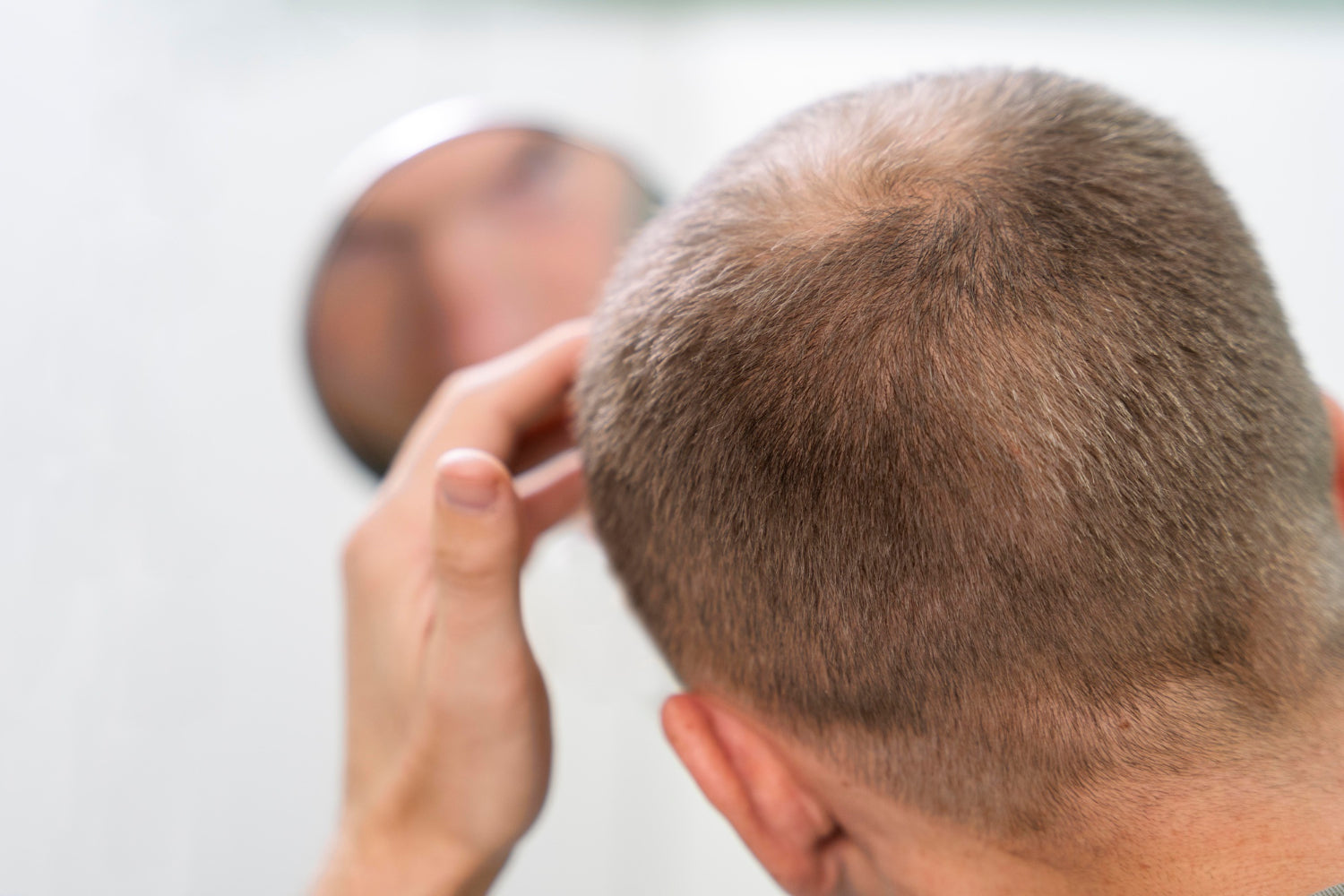 Alopecia Areata
