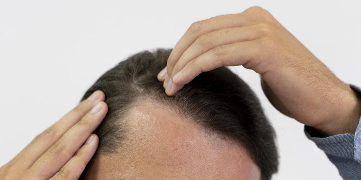 Dihydrotestosterón (DHT)